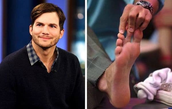 Ashton Kutcher's webbed toes