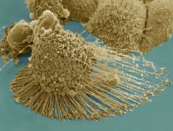 There Exists an “Immortal” Cancer Cell.