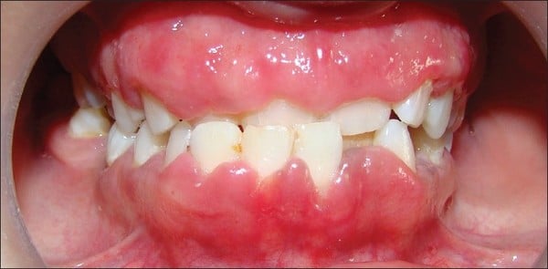 I'll Spot the Signs of Gum Disease Before it Gets Too Severe.